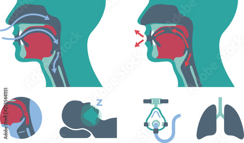 Human Airway Breathing and Sleep Apnea Medical Infographic Vector Set with CPAP Mask Throat and Lung Anatomy Illustration