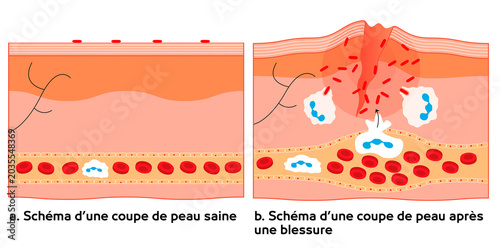 Foto Scientific illustration comparing a cross-section of healthy skin (A) to injured skin (B) showing white blood cell (neutrophil) recruitment and bacterial phagocytosis