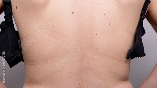 Close up of woman back with red marks from tight bra strap on skin. Female patient showing moles and underwear imprints to dermatologist during medical examination.