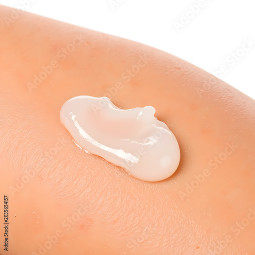 Aloe vera gel applied to sunburned skin