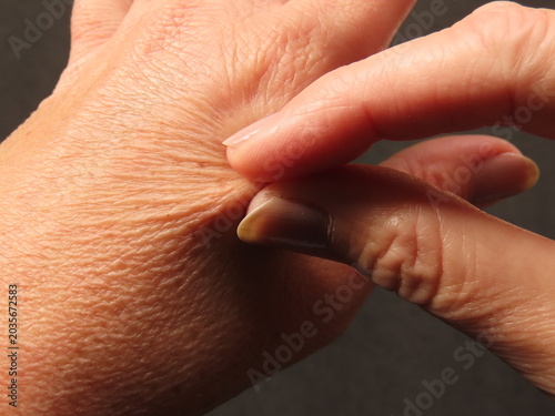 Quadro em tela Closeup of woman hands with dry, dehydrated skin and loss of elasticity