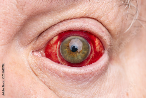 Closeup photograph of injured eyeball showing redness caused by bloody broken blood vessel of subconjunctival hemorrhage under sclera membrane