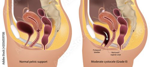 Female Pelvic Floor Anatomy Showing Grade II Cystocele and Prolapsed Bladder Cross Section Diagram. Moderate Cystocele Medical Illustration with Normal Pelvic Support Comparison and Female Pelvic 