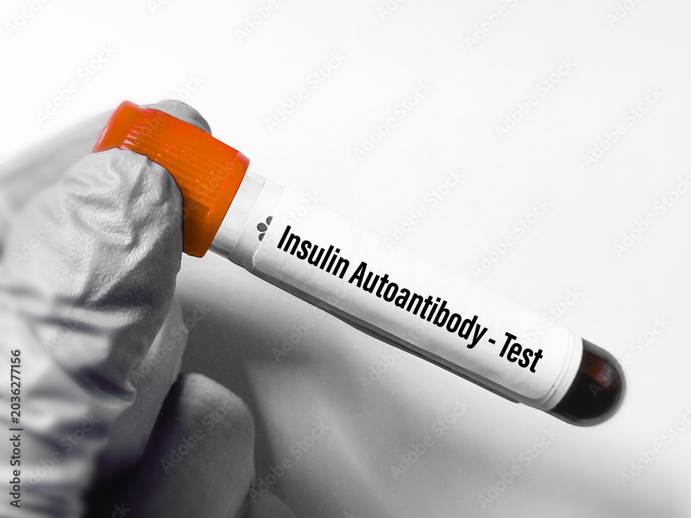 Obraz premium Hand holding Insulin autoantibody (IAA) test tube. Insulin autoantibody or Autoantibodies Against Insulin or IAA blood test.