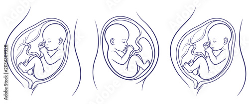 Three detailed illustrations of human fetus inside womb, showing different stages of development and position in line art style for medical education.