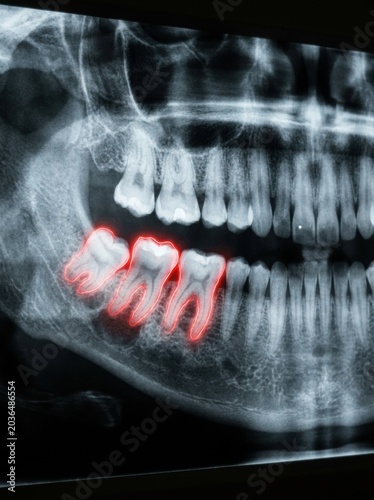 Dental X-ray Showing Tooth Abscess and Oral Health Issue in a Medical Setting