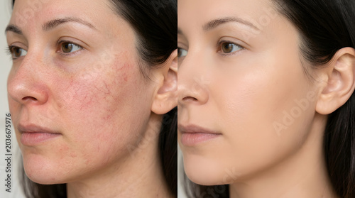 Skin redness before and after treatment | Woman face with rosacea and capillaries | Dermatological skincare results | Clear healthy skin after laser therapy | Facial rejuvenation and tone correction