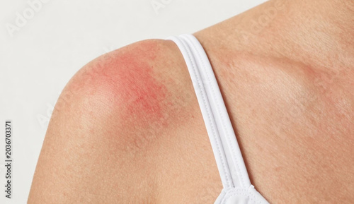 Close-up of red sunburnt skin with white tan line from swimsuit strap.
