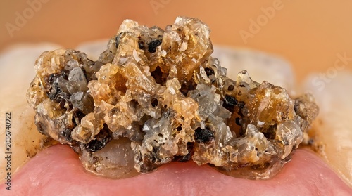 Dental calculus tartar buildup on tooth surface with mineral deposit and bacteria accumulation