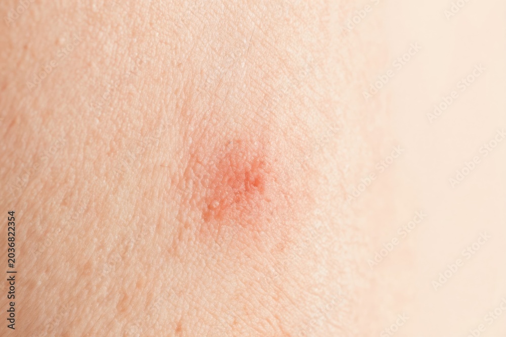 Fototapeta premium Macro view shows inflamed red skin with visible pores and ingrown hair follicle. Pimple or small wound indicates skin issue or irritation. Texture reveals human epidermis detail.