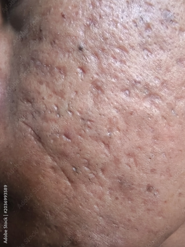 Fototapeta premium Close Up of Acne Scars and Blackheads on Facial Skin