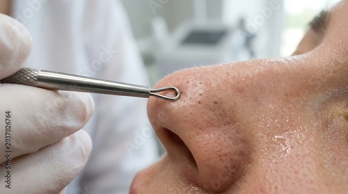 Close-up of professional blackhead extraction on nose using a metal comedone extractor, part of a skincare routine for clean skin.