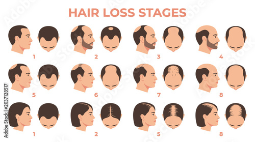 Educational medical infographic showing various progressive stages of human male and female pattern hair loss