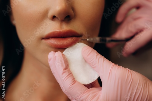 Woman getting lip filler injection for beauty enhancement