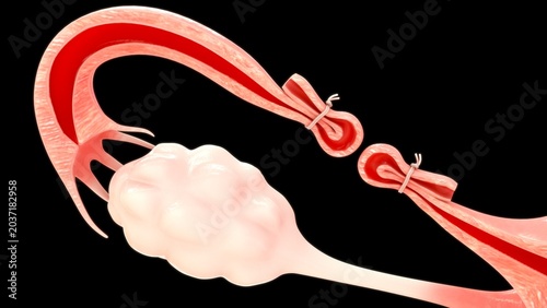 Bild auf Leinwand Female Sterilization (Tubal Occlusion) Anatomy