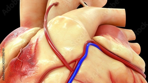Photos Coronary artery bypass grafting (CABG) is a major surgical procedure used to treat severe coronary artery disease