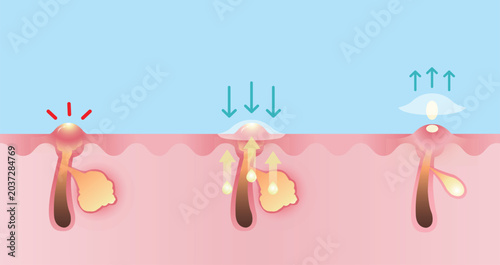 Foto Direction for use zit away patch for inflammatory acne vector illustration on blue sky background