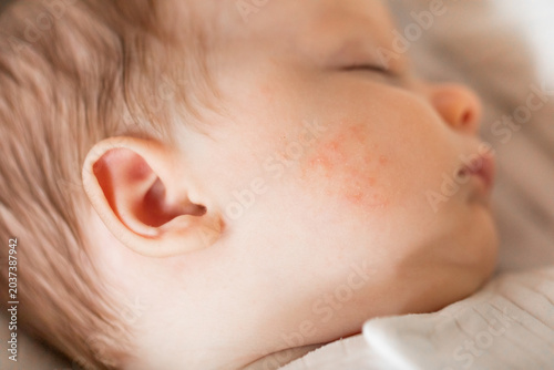 Close-up of a baby's face showing mild eczema, atopic dermatitis on the cheek, soft lighting, gentle skin detail, tenderness, infant health.