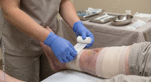 Clinician dressing venous stasis ulcer on patient swollen leg