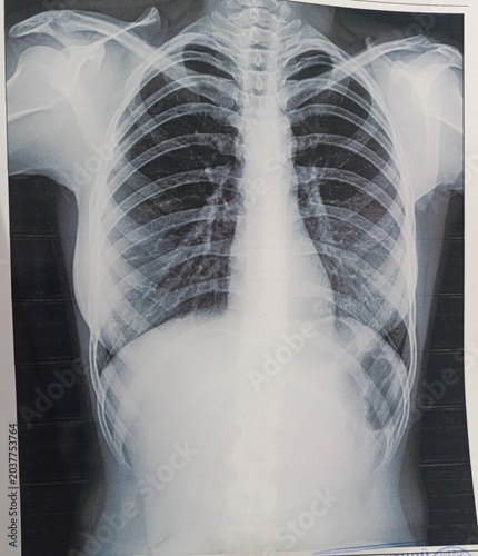 Photos Chest X-ray