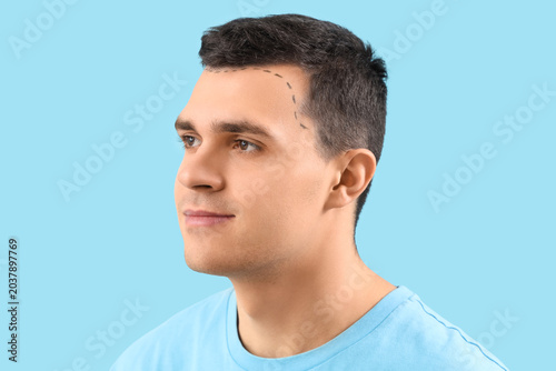 Young man with hair loss pr...
