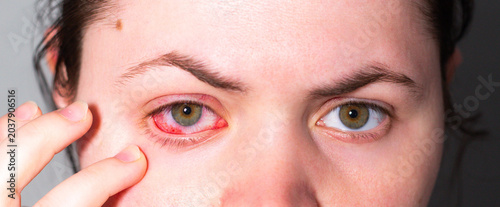 Tableau sur toile Red eye due to viral or bacterial infection