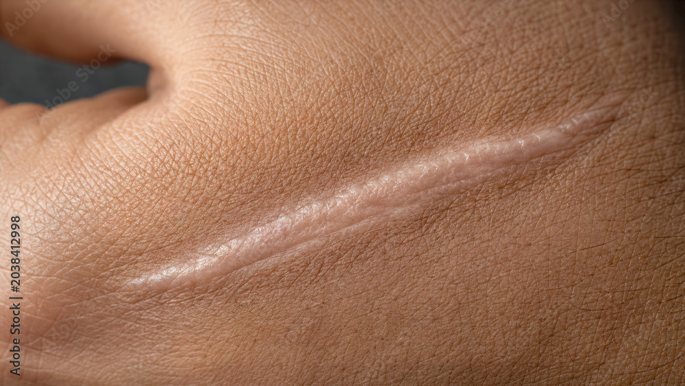 Fototapeta premium Old silver scar on a hand macro shot contrasting with surrounding skin pores and deep texture detail