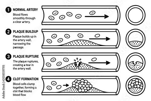 Bild auf Leinwand Artery plaque buildup and blood clot medical diagram Vector