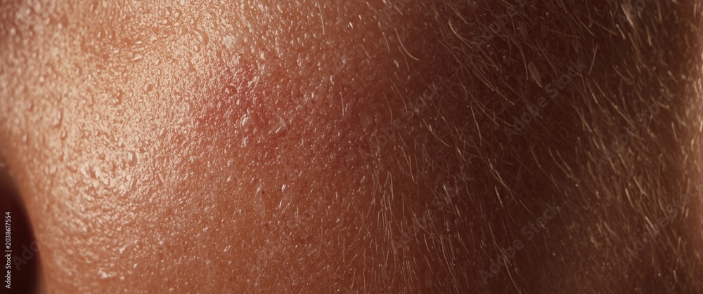 Fototapeta premium Close perspective on skin texture exposing intricate rosacea redness and detailed surface features bathed in mild light