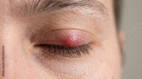 Close-up view of an irritated and painful stye on a person's upper eyelid, signaling an eye infection