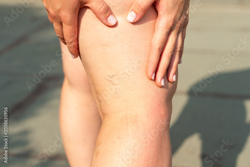 Canvas Print Close-up of a woman's hands holding her lower leg with visible small varicose veins on the calf outdoors during summer