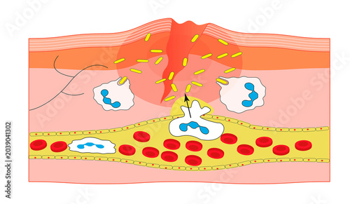 Foto Scientific illustration comparing a cross-section of healthy skin (A) to injured skin (B) showing white blood cell (neutrophil) recruitment and bacterial phagocytosis
