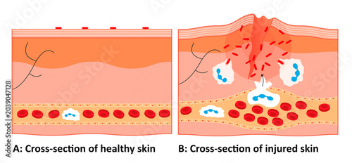Bild auf Leinwand Scientific illustration comparing a cross-section of healthy skin (A) to injured skin (B) showing white blood cell (neutrophil) recruitment and bacterial phagocytosis