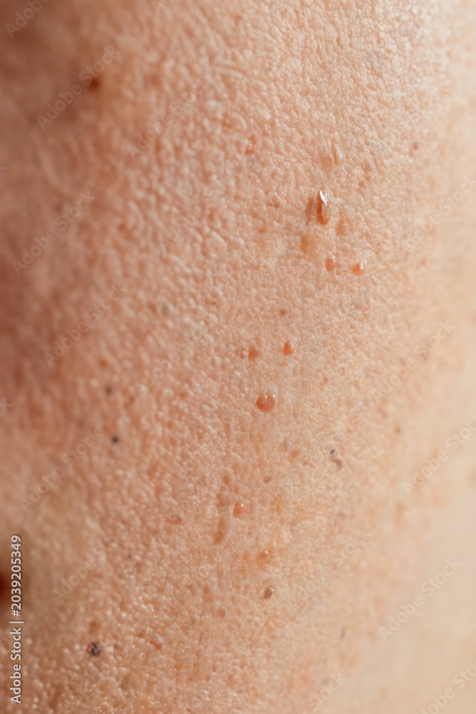 Fototapeta premium Macro view of human skin texture with visible pores enlarged oil glands, small dark spots. Tiny water droplets sit on uneven surface creating slightly wet look. Areas show slight redness irritation.