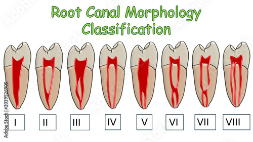 Tableau sur toile Root Canal Morphological Classification Chart, Endodontic Pulp System Anatomy an