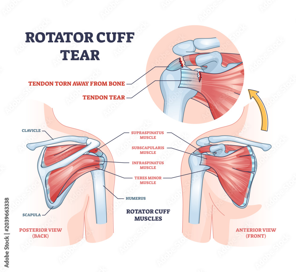 Obraz premium Rotator cuff tear as shoulder muscle trauma or arm injury outline diagram, transparent background. Labeled educational upper body anatomy with medical tendon torn away from bone illustration.