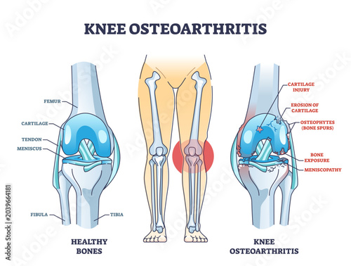 Fotografija Knee osteoarthritis condition with skeletal bone degeneration outline diagram, transparent background