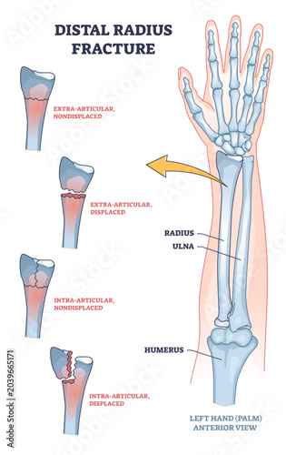Fényképezés Distal radius fracture and broken arm bone types anatomy outline diagram, transparent background