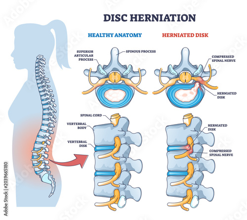 Disc herniation or spine nerve compression vs healthy anatomy outline diagram, transparent background. Labeled educational scheme with superior articular process and herniated disk illustration.