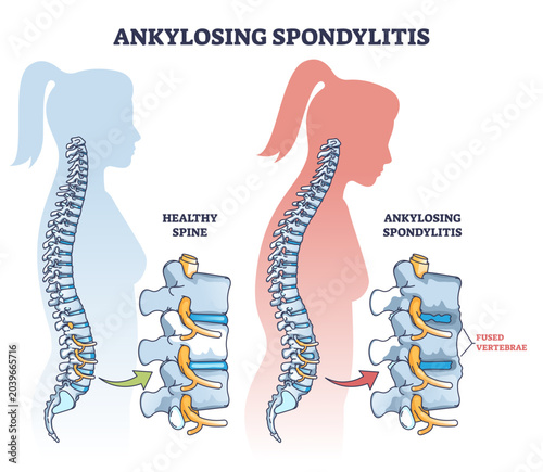 Konstfotografi Ankylosing spondylitis as inflammatory spine bone disease outline diagram, transparent background