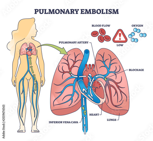 Photos Pulmonary embolism with blood flow blockage in lung artery outline diagram, transparent background