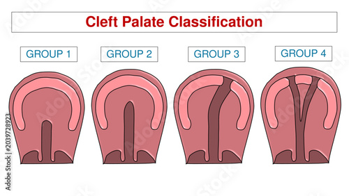 Bild auf Leinwand Cleft Palate Anatomical Classification Chart, Congenital Palatal Defect Severity