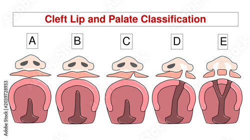 Obraz na plátne Cleft Lip and Palate Anatomical Classification Chart, Congenital Lip and Palatal