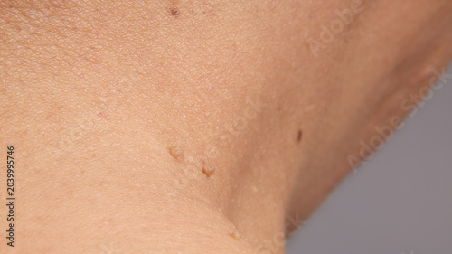 Close up view of human skin showing warts and skin tag