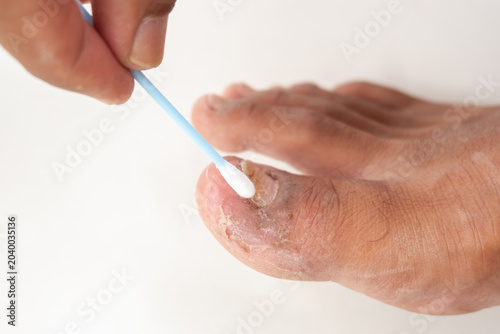 Applying Antifungal Treatment on Infected Toenail