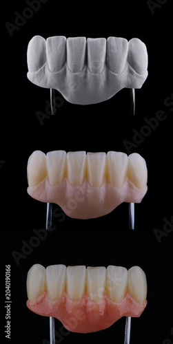 Three stages of making full dental zirconium prosthesis on titanium bar. Dental care concept.