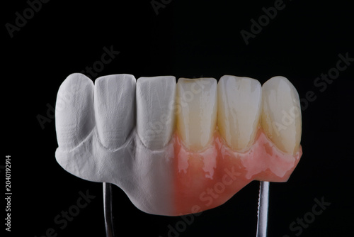 Two stages of making dental zirconium prosthesis on titanium abutments. Dental care concept.