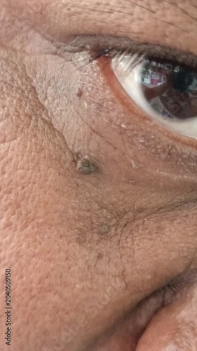 Macro Extreme Close Up of a Man Pointing to a Skin Tag Wart Near His Eye