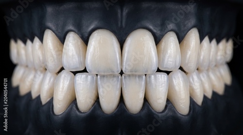 Aesthetic Dental Veneers and Porcelain Crowns on Black Model Background, High-End Cosmetic Dentistry for Perfect Smile, Professional Medical Prosthodontics Restoration Studio Shot