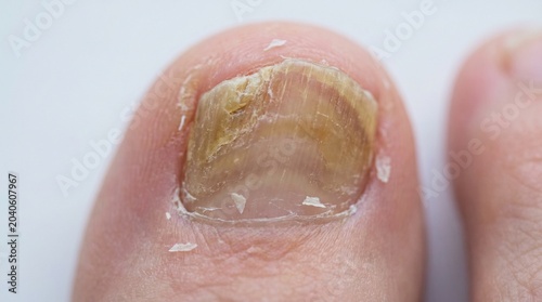 Extreme Close-up of Toenail Fungus Infection (Onychomycosis)